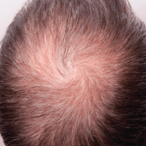 vlasova-mezoterapie-pred-po2