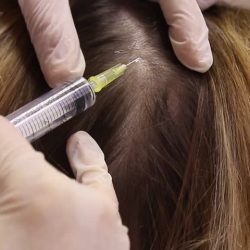 vlasova-mezoterapie-zakrok